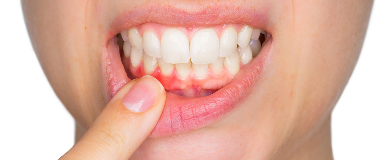 home remedies for gingivitis