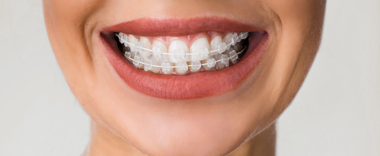 Ceramic braces