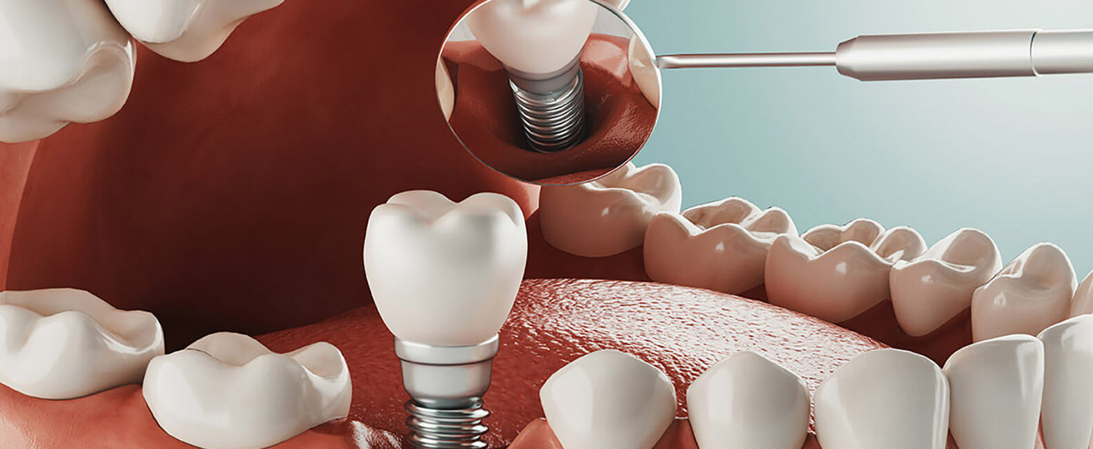dental implants Turkey teeth