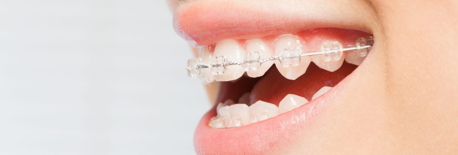 ceramic braces