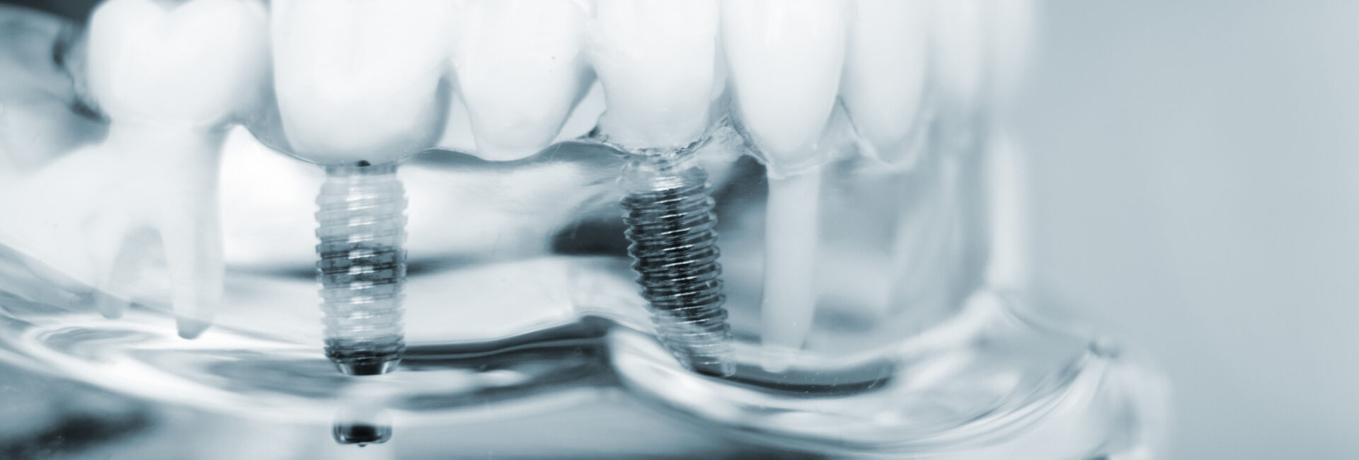 Australian-made dental implants