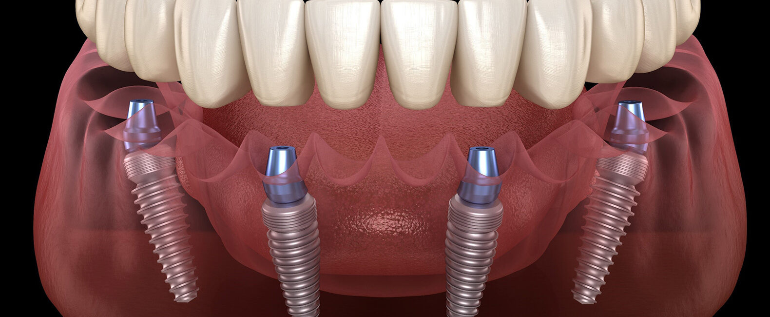 All On Four dental implants procedure