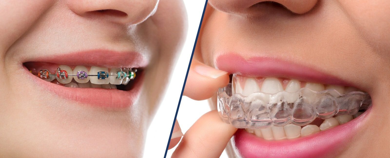 Ceramic Or Metal Braces Vs. Clear Aligners