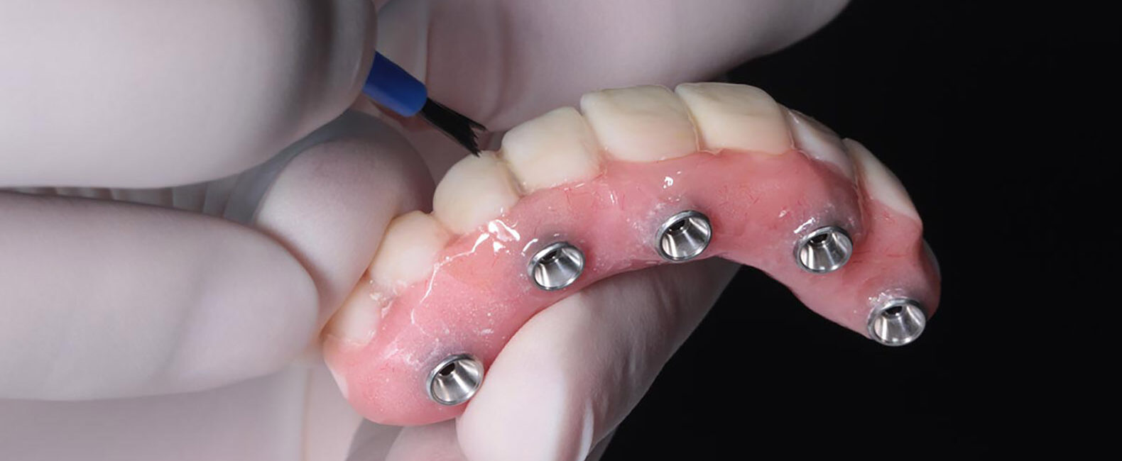 all-on-four dental implants