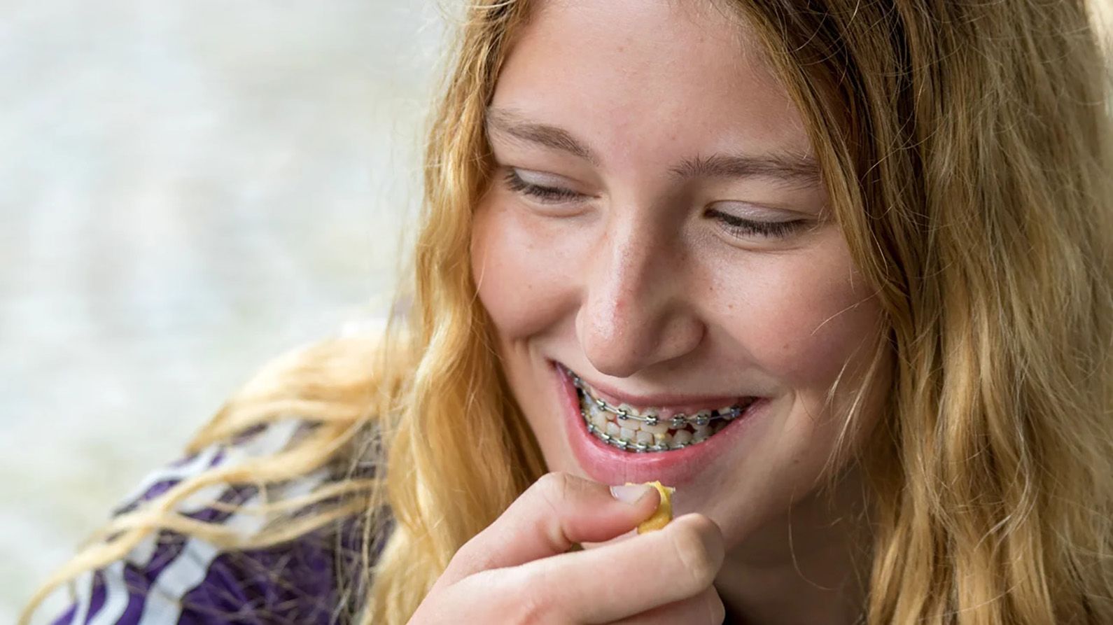 Orthodontic Treatments & Braces for Excessive Lip Support Dental