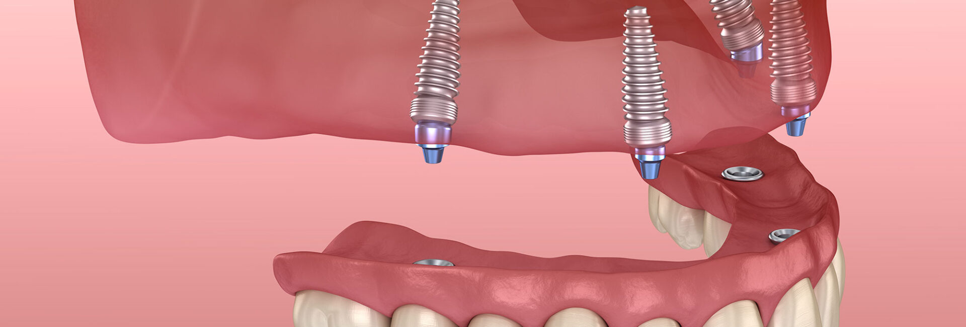 all-on-four teeth replacement