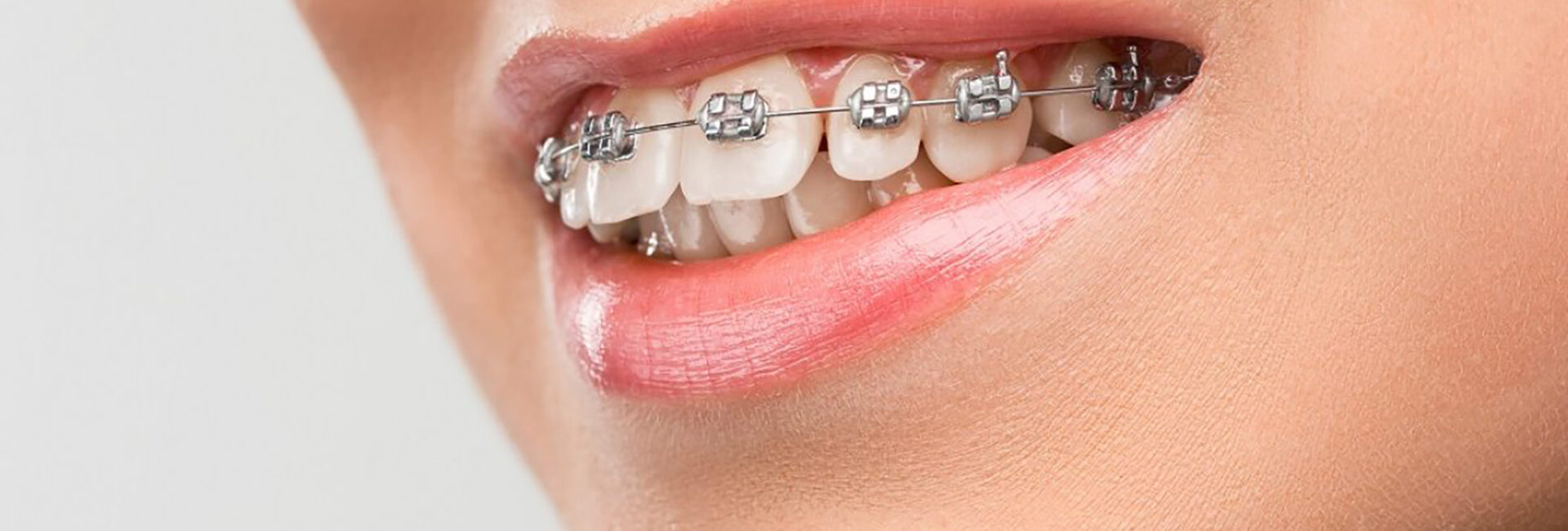 dental braces