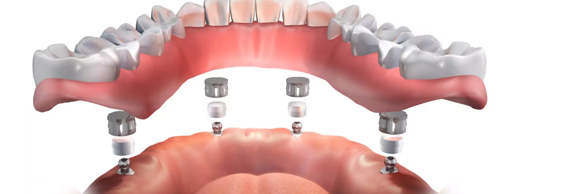 all on 4 plus dental implants