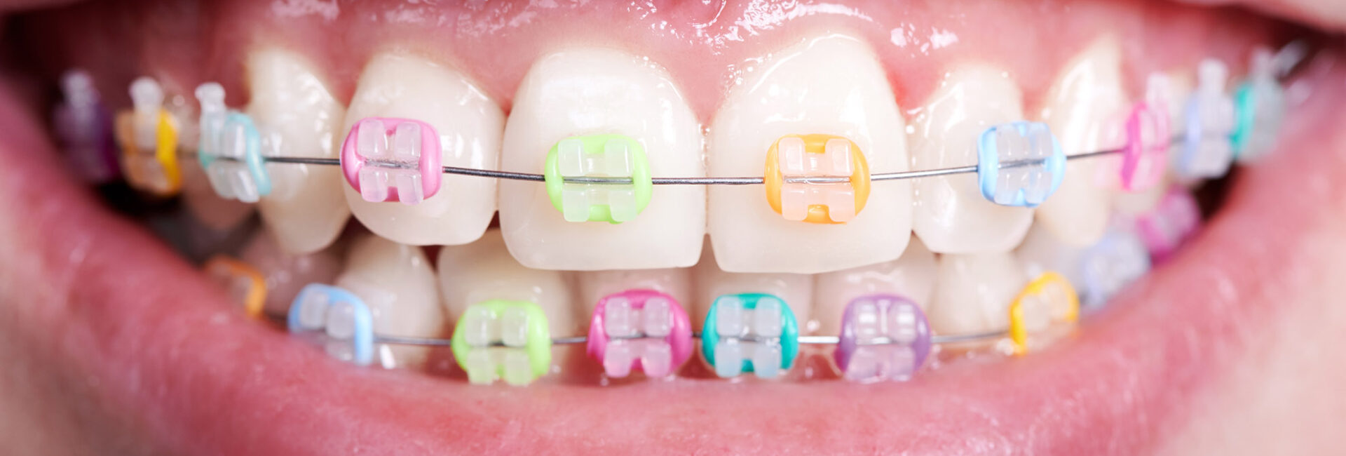 Psychedelic coloured braces