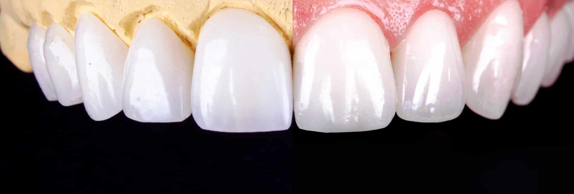 composite veneers