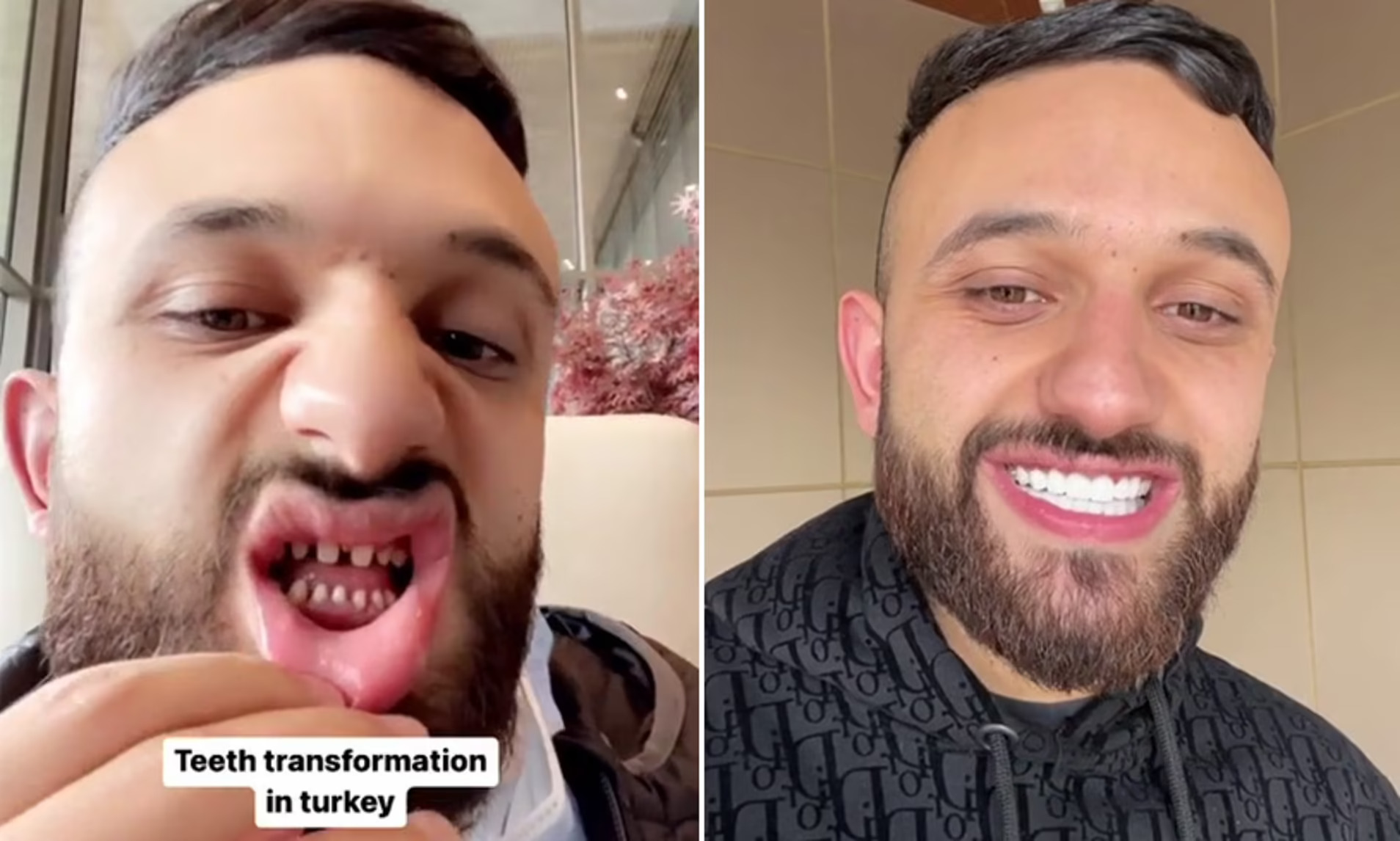 Turkey Teeth Are A Dental Fiasco turkey-teeth-are-a-dental-fiasco