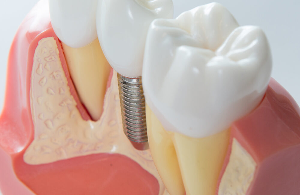 dental implants