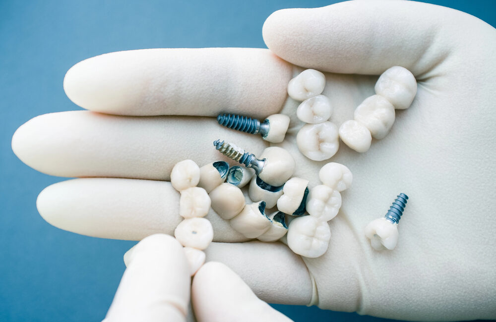 dental implants