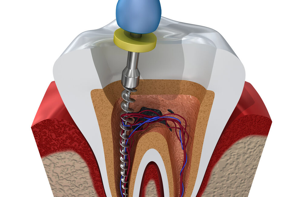 root canal treatment