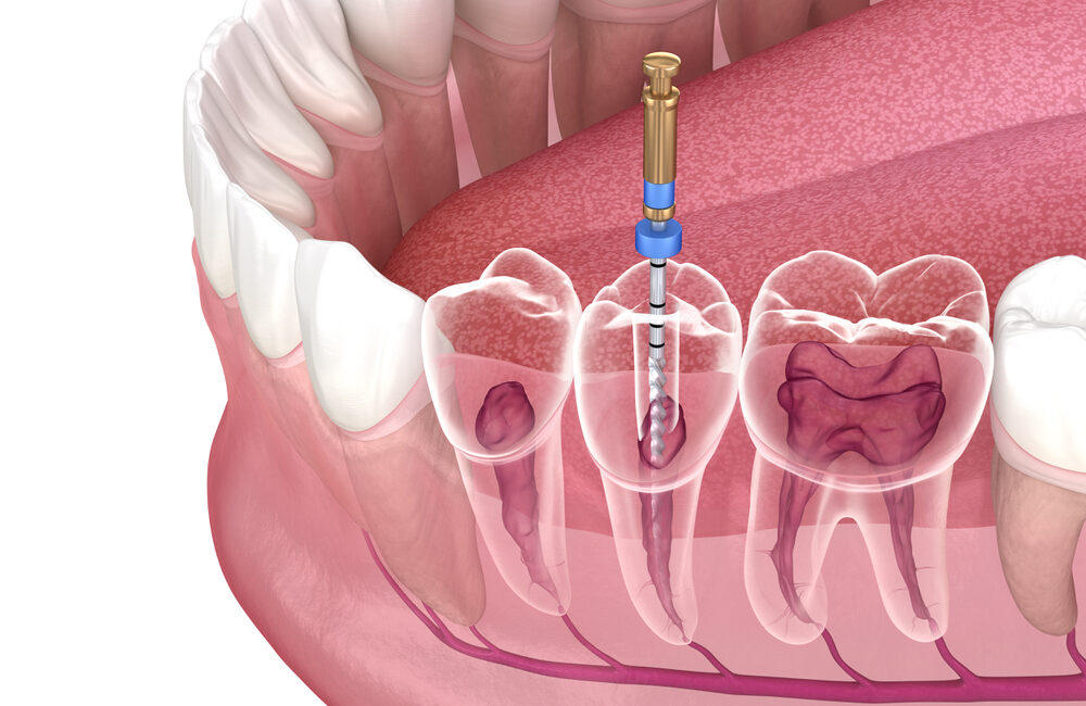 root canal treatment