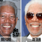 Celebrity Smile Makeover