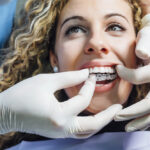Clear Aligners