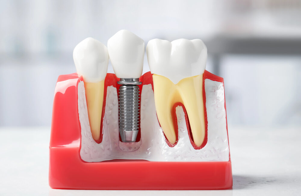 dental implants