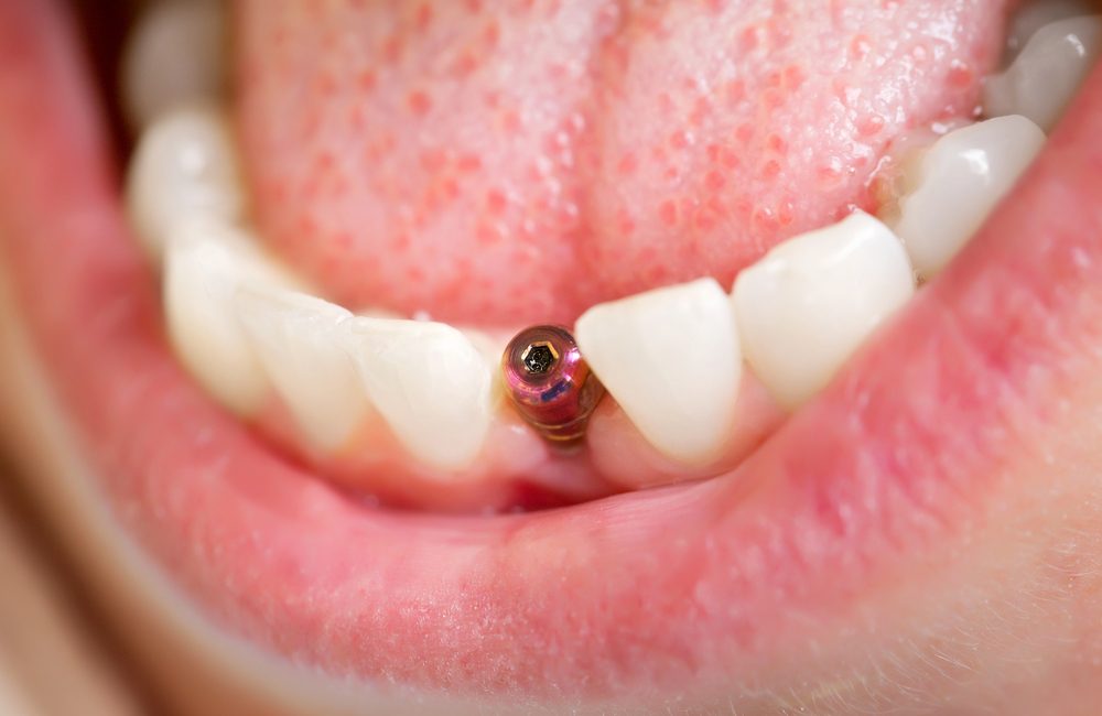 Dental implants