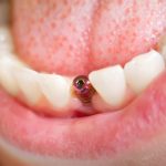 Dental implants