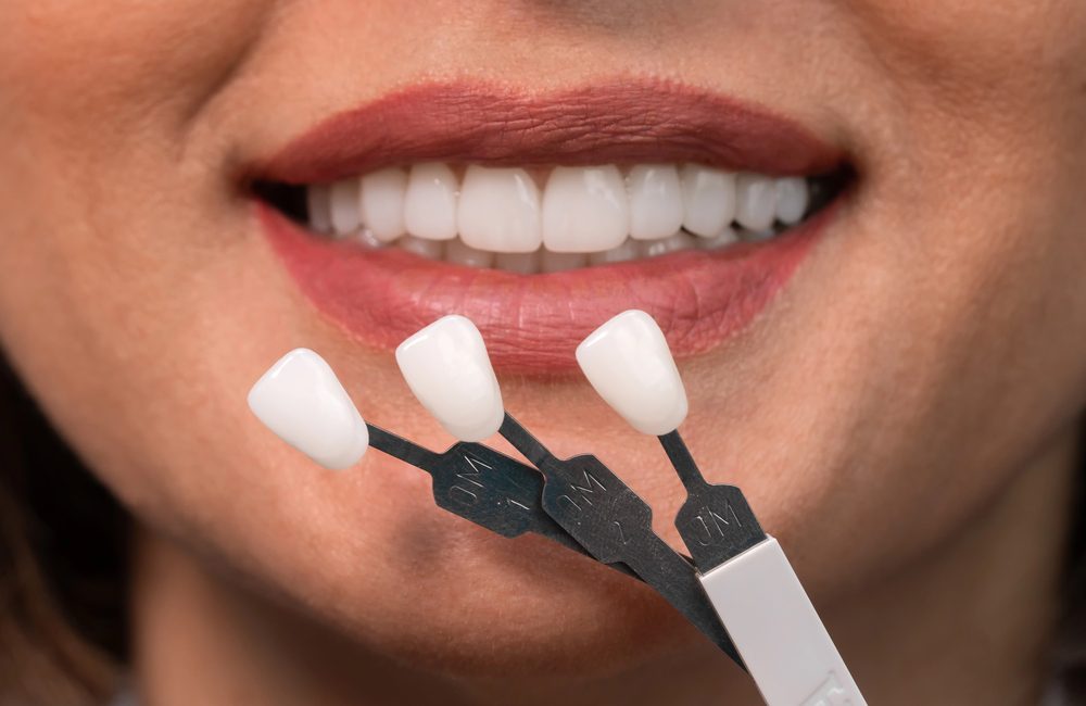 Dental Veneers