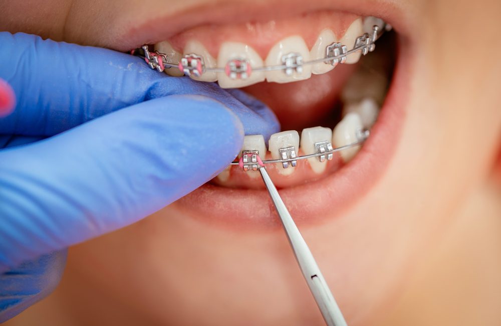 orthodontic treatment