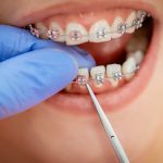 orthodontic treatment
