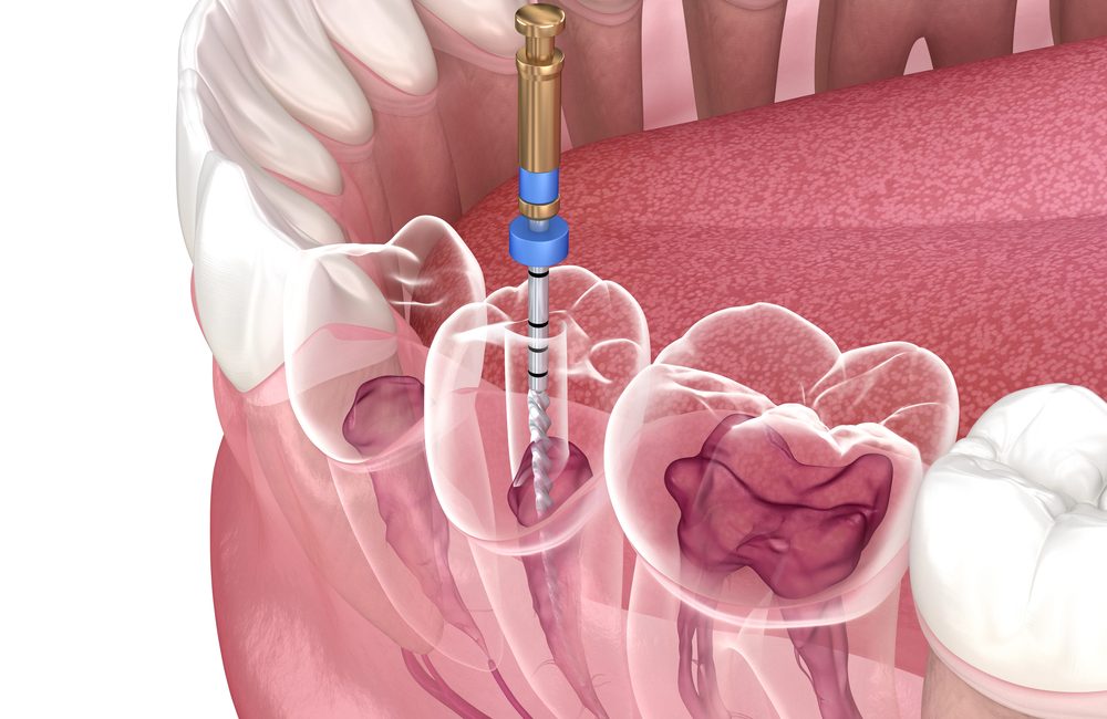 root canal dentistry