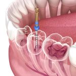 root canal dentistry