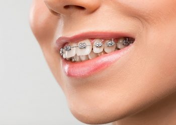 dental braces