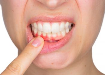 home remedies for gingivitis