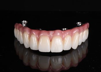 All On 4 Dental Implants