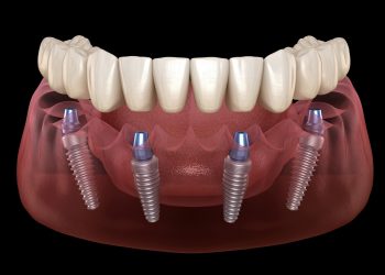 All On Four dental implants procedure