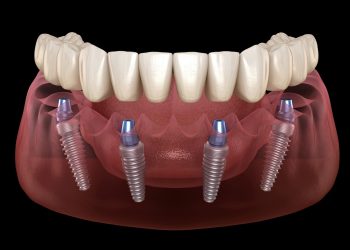 All On Four dental implants procedure