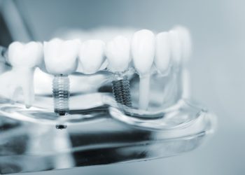 Australian-made dental implants
