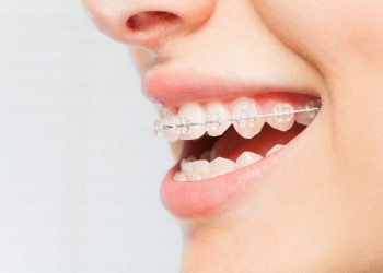 ceramic braces