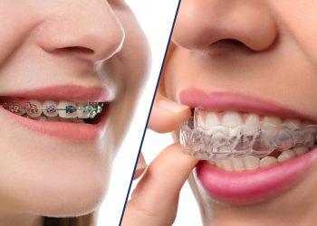 Ceramic Or Metal Braces Vs. Clear Aligners