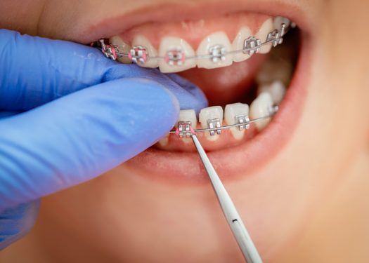 orthodontic treatment