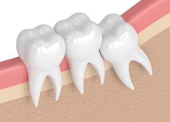 Wisdom Tooth Removal