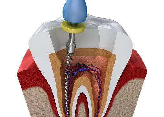 root canal treatment