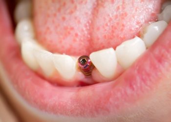 Dental implants