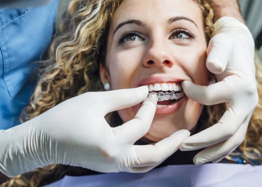 Clear Aligners