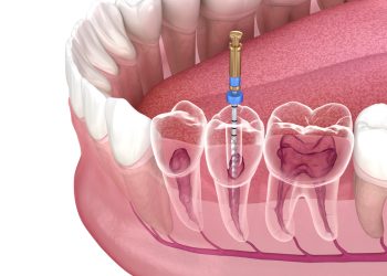 root canal treatment