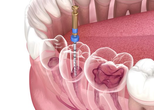 root canal dentistry