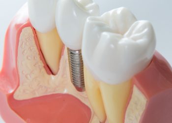 dental implants