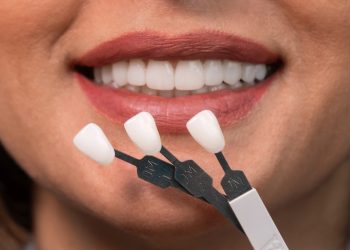 Dental Veneers