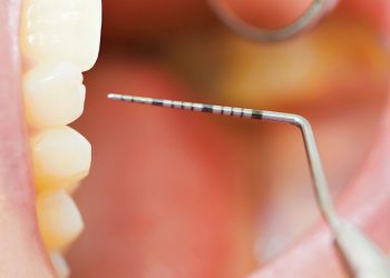 gingivitis and periodontal disease