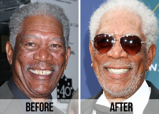 Celebrity Smile Makeover