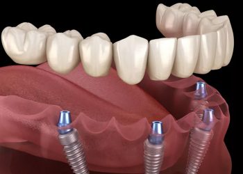 One Day Dental Implants Pros and Cons