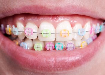 Psychedelic coloured braces